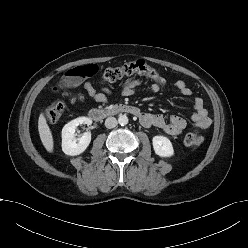 Acute appendicitis - large appendicoliths (Radiopaedia 61805-69820 Axial C+ portal venous phase 62).jpg