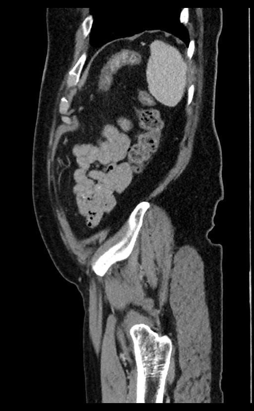 Acute appendicitis - large appendicoliths (Radiopaedia 61805-69820 Sagittal C+ portal venous phase 16).jpg