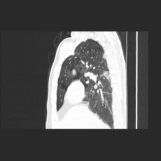 Acute appendicitis and COVID 19 pneumonia (Radiopaedia 76604-88380 Sagittal lung window 34).jpg