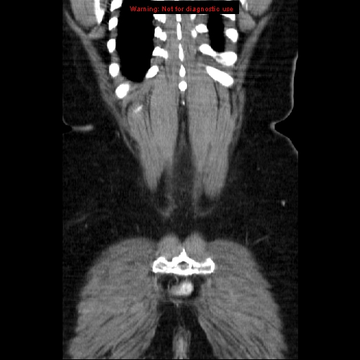 Acute appendicitis complicated by ovarian vein thrombophlebitis (Radiopaedia 16172-15851 Coronal C+ portal venous phase 74).jpg