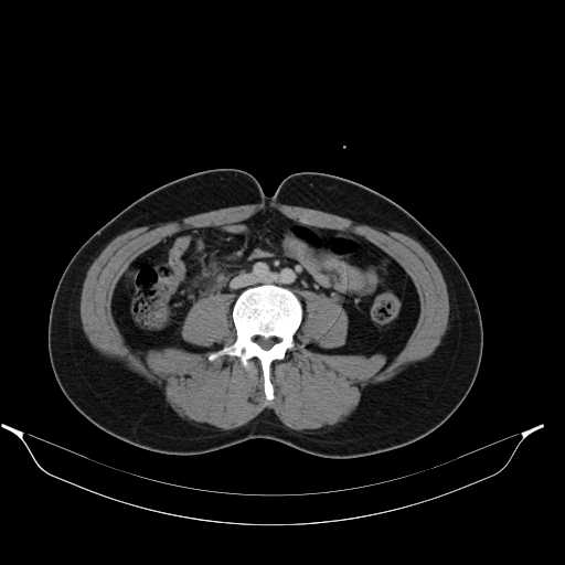 File:Acute appendicitis with appendicoliths (Radiopaedia 21148-21062 Axial C+ portal venous phase 4).jpg
