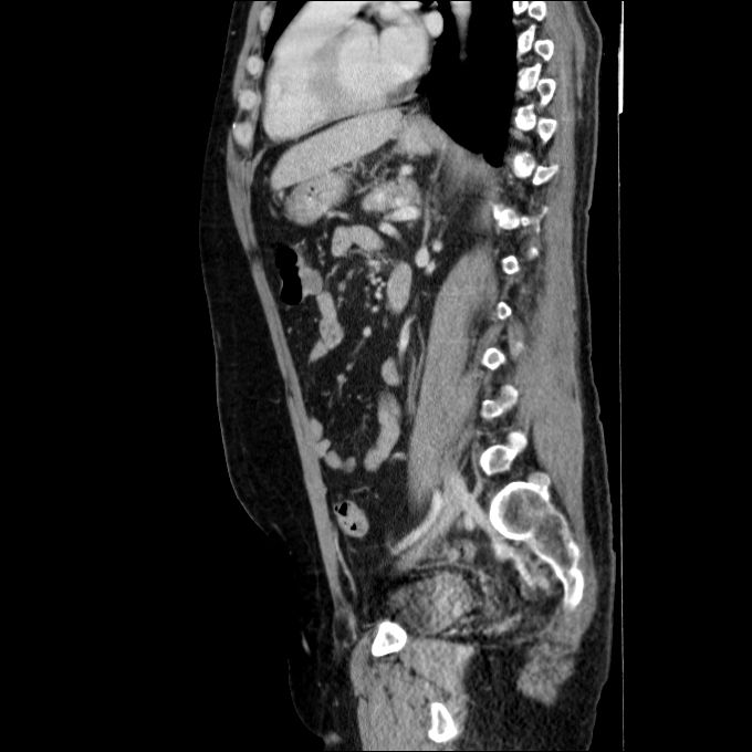 Acute cholecystitis and incidental left sided IVC (Radiopaedia 49352-54459 Sagittal C+ portal venous phase 39).jpg