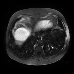 File:Acute cholecystitis complicated by pylephlebitis (Radiopaedia 65782-74915 Axial arterioportal phase T1 C+ fat sat 3).jpg