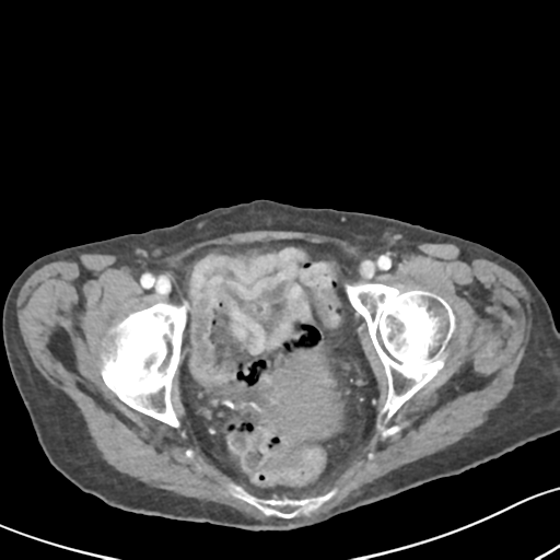 Acute cholecystitis with contained perforation (Radiopaedia 47328-51907 Axial C+ portal venous phase 67).png