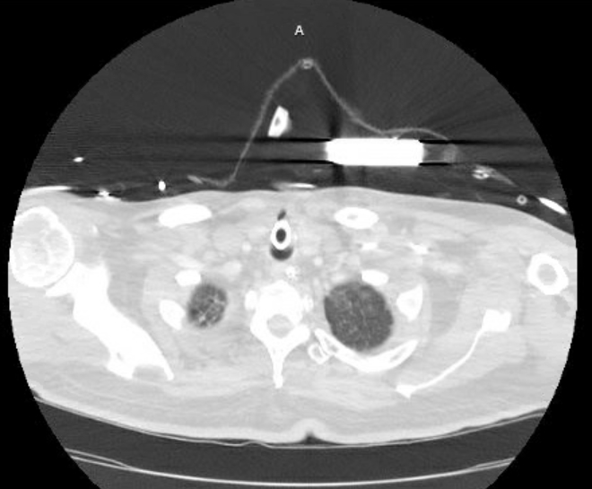 Acute cor pulmonale (ultrasound) (Radiopaedia 83508-98818 Axial lung window 5).jpg