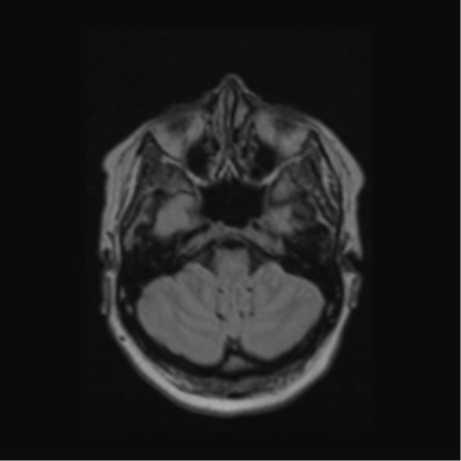 Acute disseminated encephalomyelitis (ADEM) (Radiopaedia 38073-40065 Axial FLAIR 11).png