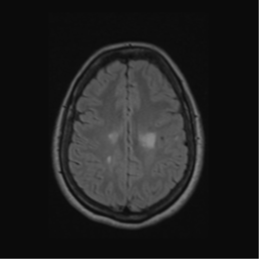 Acute disseminated encephalomyelitis (ADEM) (Radiopaedia 38073-40065 Axial FLAIR 47).png