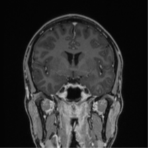 File:Acute disseminated encephalomyelitis (ADEM) (Radiopaedia 65319-74349 Coronal T1 C+ 30).png