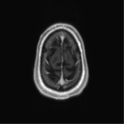 Acute disseminated encephalomyelitis (ADEM) (Radiopaedia 65319-74350 Axial T1 C+ 61).png