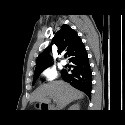 Acute epicardial fat necrosis (Radiopaedia 42327-45440 Sagittal C+ CTPA 29).jpg