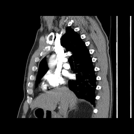 Acute epicardial fat necrosis (Radiopaedia 42327-45440 Sagittal C+ CTPA 31).jpg