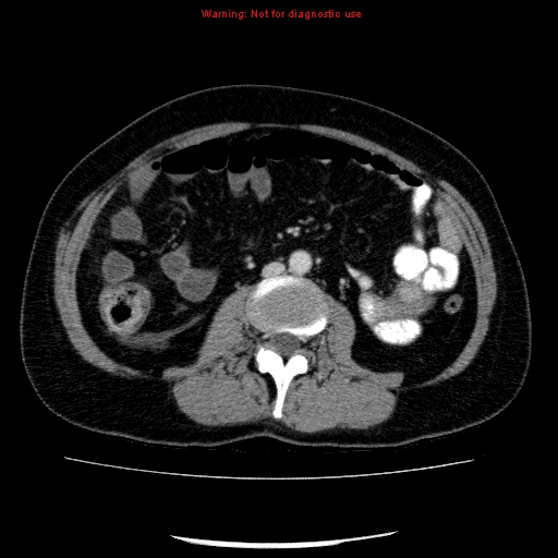 Acute gangrenous cholecystitis (Radiopaedia 10123-10661 Axial C+ portal venous phase 56).jpg