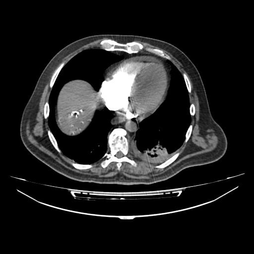 Acute heart failure (CT) (Radiopaedia 79835-93075 Axial C+ arterial phase 43).jpg