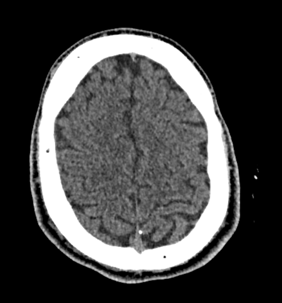 Acute ischemic stroke - posterior circulation territory (Radiopaedia 77670-89881 non-contrast 74).jpg
