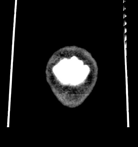 File:Acute left anterior cerebral artery territory infarction (Radiopaedia 51785-57578 Coronal non-contrast 61).jpg