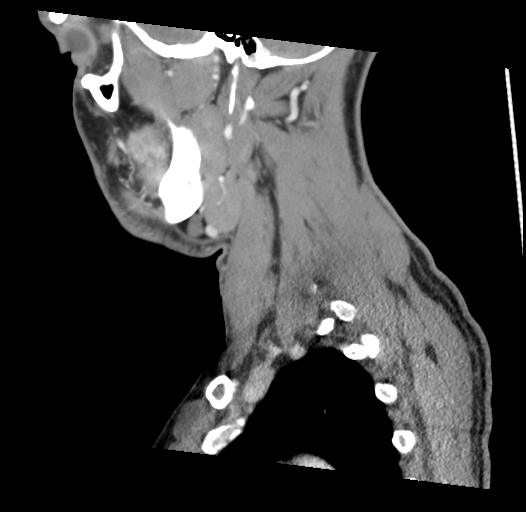 Acute longus colli calcific tendinitis (Radiopaedia 72495-83036 Sagittal C+ arterial phase 14).jpg