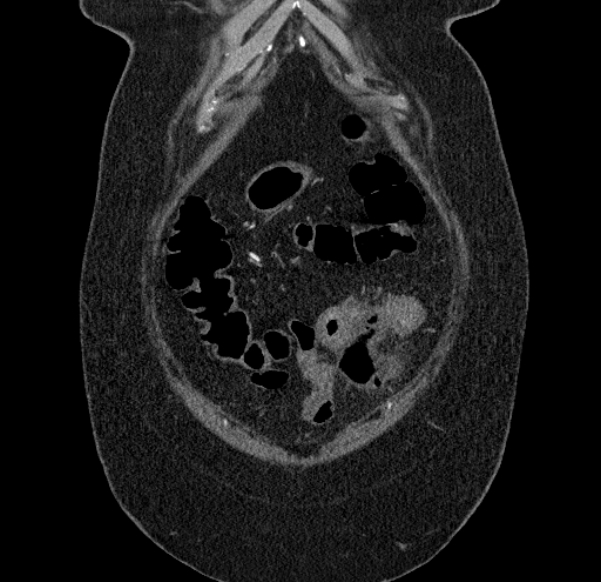 Acute mesenteric ischemia (Radiopaedia 80029-93316 Coronal C+ arterial phase 14).jpg
