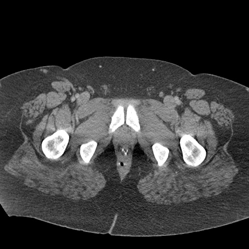 Acute mesenteric venous ischemia (Radiopaedia 46041-50383 Axial C+ portal venous phase 149).jpg