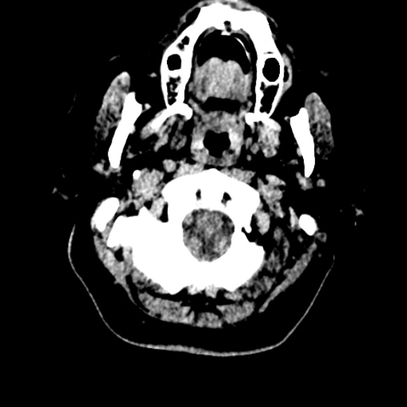 Acute middle cerebral artery territory infarct (Radiopaedia 52380-58283 Axial non-contrast 1).jpg