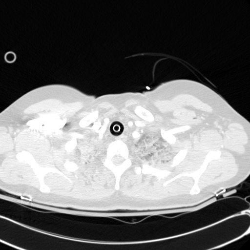 Acute myocardial infarction in CT (Radiopaedia 39947-42415 Axial lung window 10).jpg