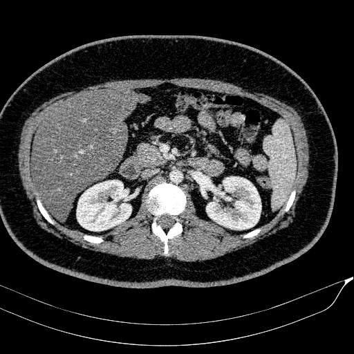 Acute on chronic pancreatitis (Radiopaedia 80902-94423 Axial C+ portal venous phase 70).jpg