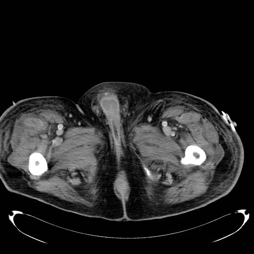 Acute pancreatic necrosis (Radiopaedia 13560-18503 Axial C+ portal venous phase 94).jpg