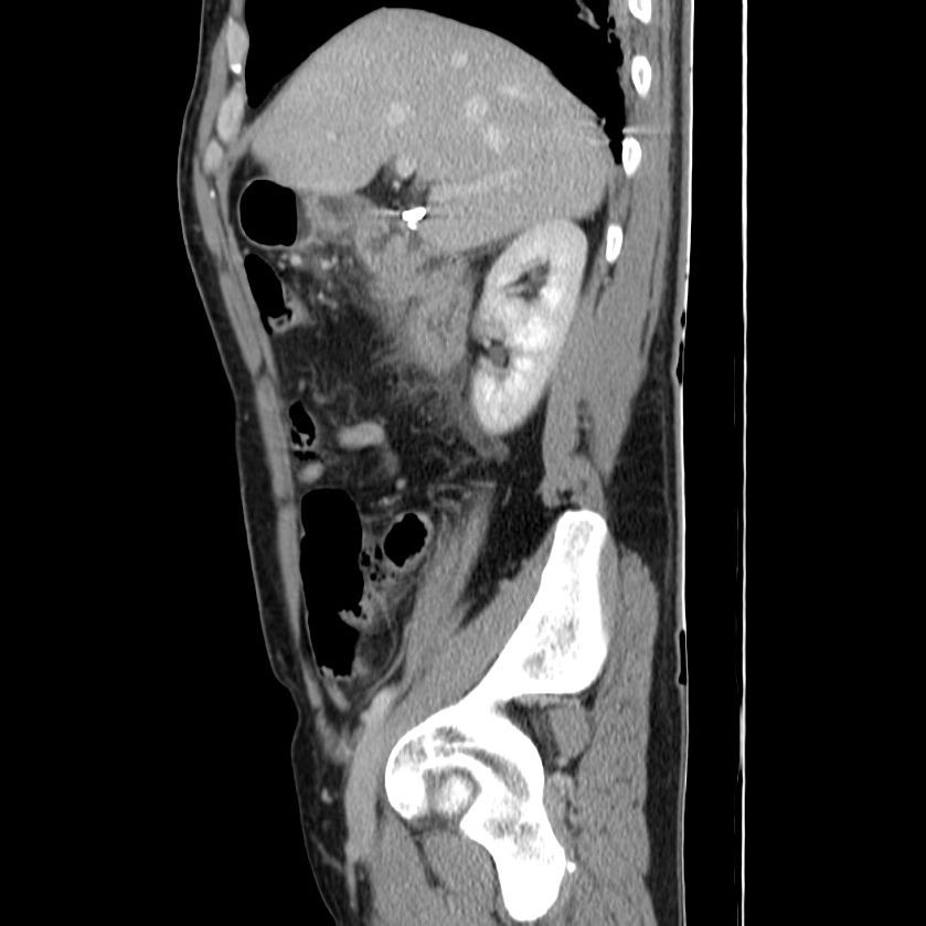 Acute pancreatitis (Radiopaedia 22572-22596 Sagittal C+ portal venous phase 17).jpg