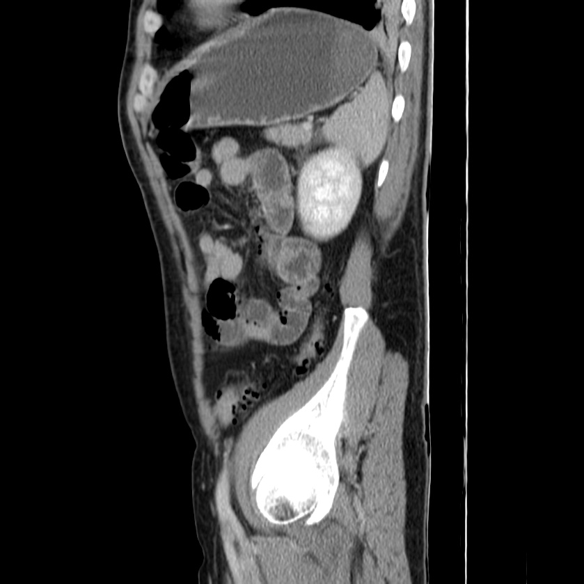 Acute pancreatitis (Radiopaedia 22572-22596 Sagittal C+ portal venous phase 42).jpg