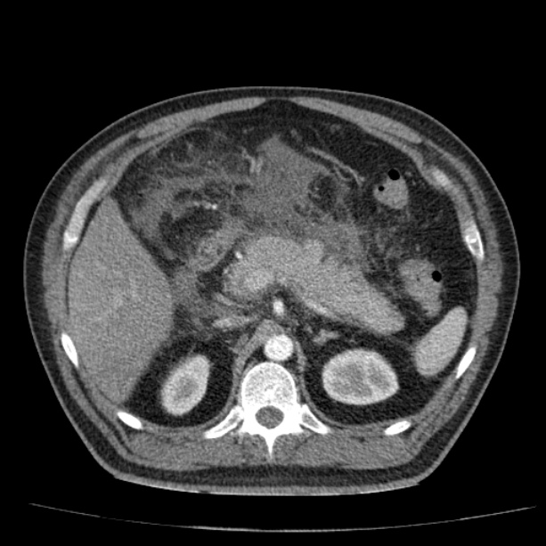 Acute pancreatitis (Radiopaedia 26663-26813 Axial C+ arterial phase 34).jpg
