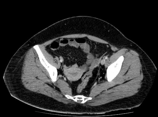 Acute pancreatitis (Radiopaedia 69236-79012 Axial C+ portal venous phase 78).jpg