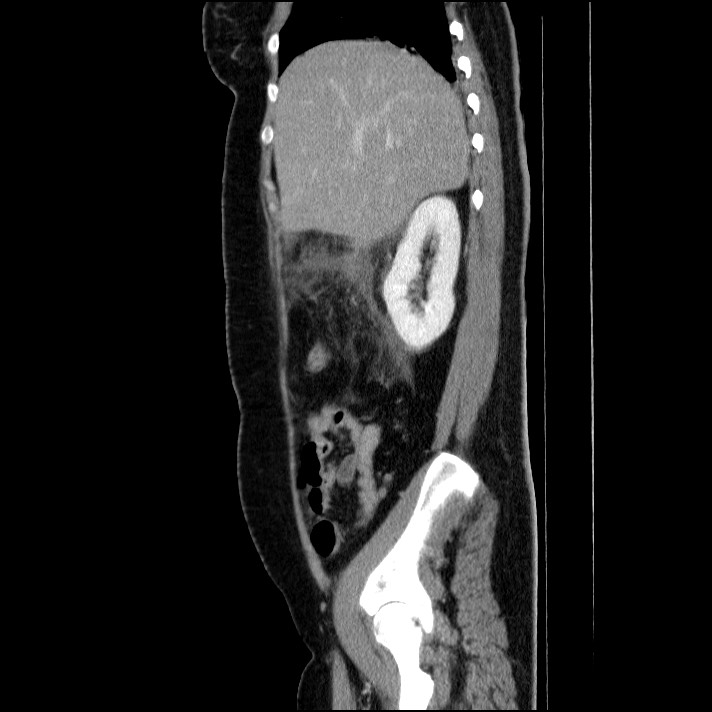 Acute pancreatitis (Radiopaedia 69236-79012 Sagittal C+ portal venous phase 72).jpg