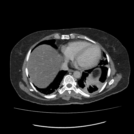Acute pancreatitis (Radiopaedia 80007-93285 Axial C+ portal venous phase 5).jpg