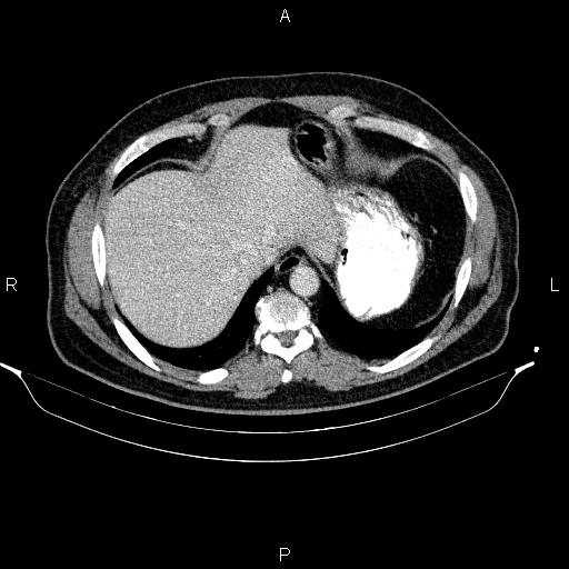 Acute pancreatitis (Radiopaedia 85390-101010 Axial C+ portal venous phase 14).jpg