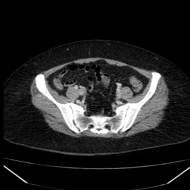 Acute pancreatitis - Balthazar C (Radiopaedia 26569-26714 Axial C+ portal venous phase 76).jpg