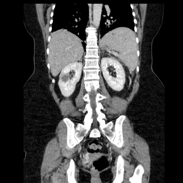 Acute pancreatitis - Balthazar C (Radiopaedia 26569-26714 Coronal C+ portal venous phase 48).jpg