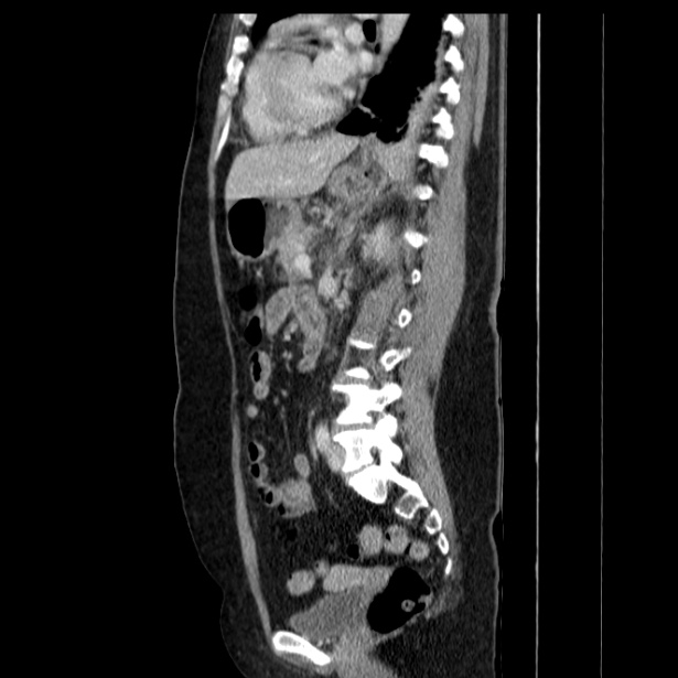 Acute pancreatitis - Balthazar C (Radiopaedia 26569-26714 Sagittal C+ portal venous phase 40).jpg