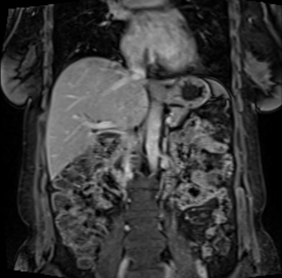 Acute pancreatitis - Balthazar E - post ERCP (Radiopaedia 27562-27778 Coronal T1 C+ fat sat 34).png