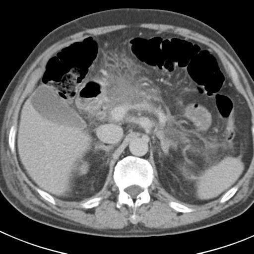 Acute pancreatitis and walled-off necrosis (Radiopaedia 29888-30403 Axial C+ delayed 28).jpg