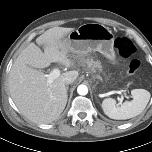 File:Acute pancreatitis and walled-off necrosis (Radiopaedia 29888-30403 Axial C+ portal venous phase 8).jpg