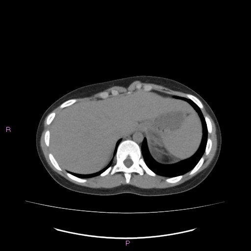 File:Acute pancreatitis secondary to stone at minor papilla and pancreatic divisum (Radiopaedia 76570-88333 Axial non-contrast 12).jpg