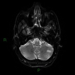 File:Acute posterior cerebral artery territory infarct (Radiopaedia 79329-92394 Axial DWI 35).jpg