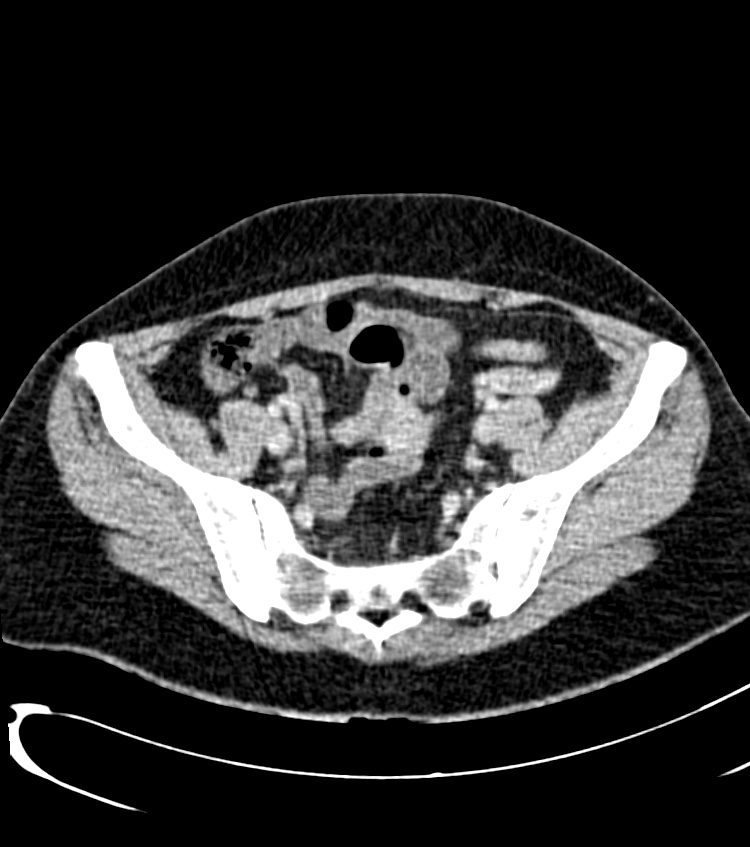 Acute pyelonephritis (Radiopaedia 40264-42816 Axial C+ portal venous phase 53).jpg