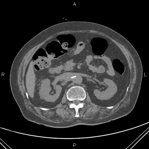 File:Acute renal artery occlusion (Radiopaedia 86586-102682 Axial non-contrast 28).jpg