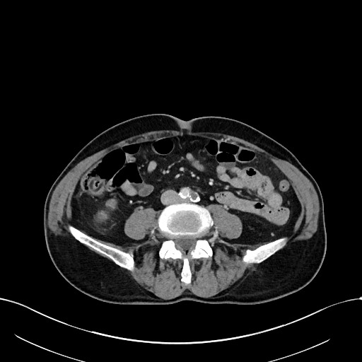 Acute renal infarction (Radiopaedia 59375-66736 Axial C+ portal venous phase 64).jpg