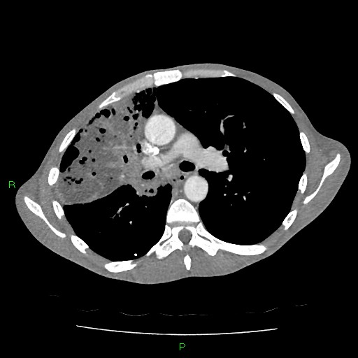 File:Acute right lung abscess (Radiopaedia 34806-36258 Axial C+ arterial phase 79).jpg