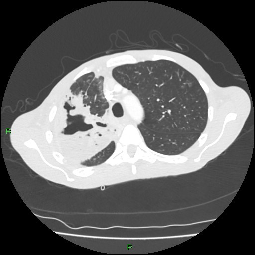 Acute right lung abscess (Radiopaedia 34806-36258 Axial lung window 50).jpg