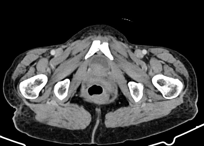 File:Acute small bowel (ileal) volvulus (Radiopaedia 71740-82139 Axial C+ portal venous phase 201).jpg
