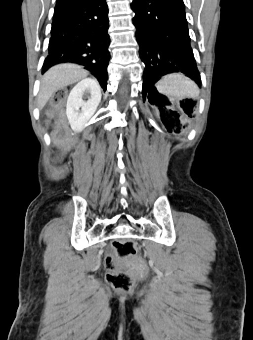 Acute small bowel (ileal) volvulus (Radiopaedia 71740-82139 Coronal C+ portal venous phase 91).jpg