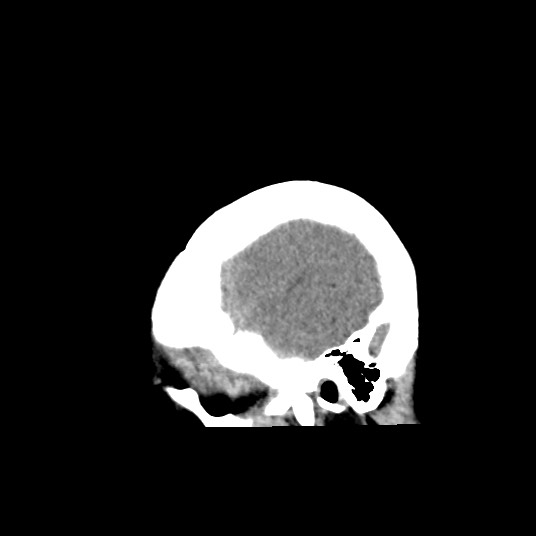 Acute subarachnoid hemorrhage and accessory anterior cerebral artery (Radiopaedia 69231-79008 Sagittal non-contrast 51).jpg