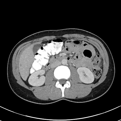 File:Acute uncomplicated appendicitis (Radiopaedia 61374-69304 Axial 55).jpg